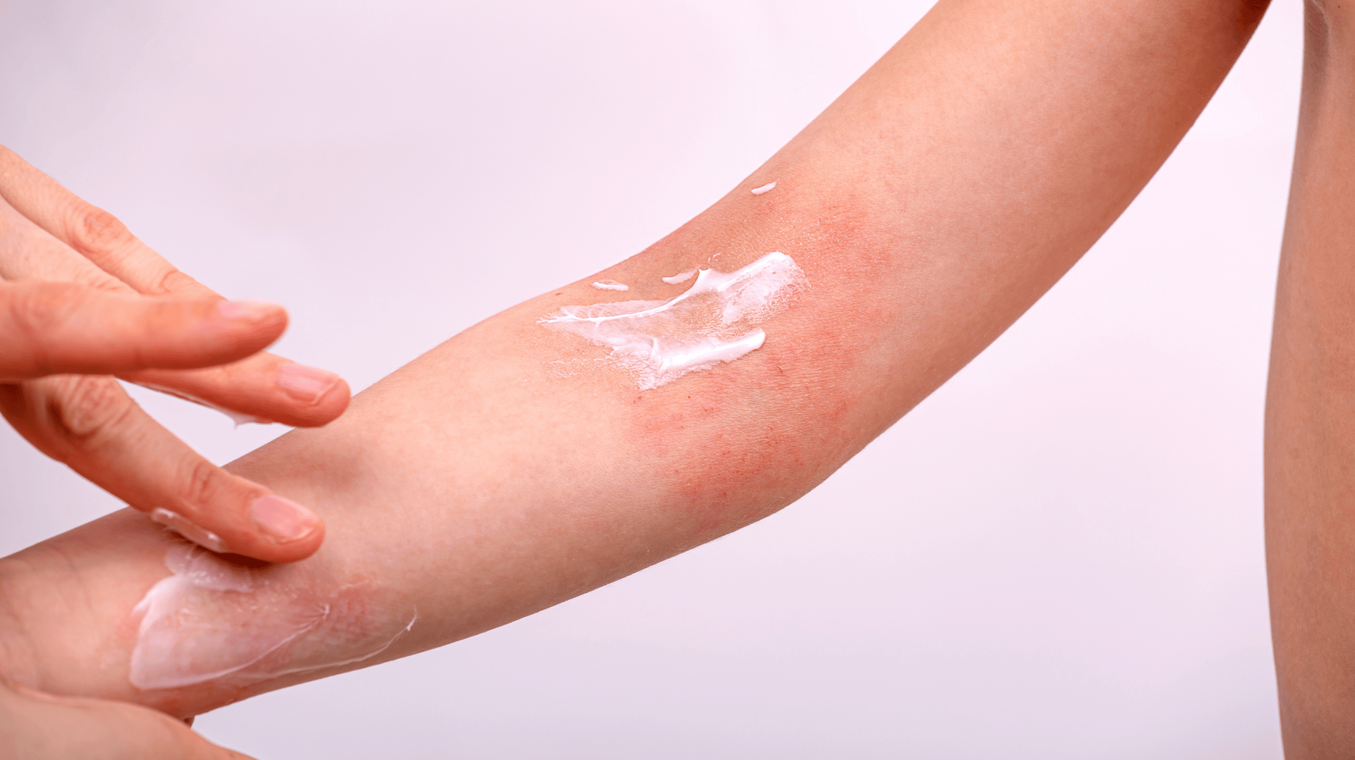 Managing Kids’ Eczema in Singapore: Clothing, Skincare & Care Tips - Nimbu